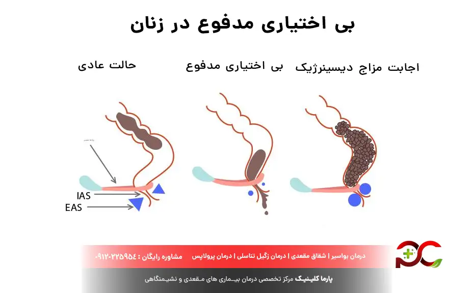 علت بی اختیاری مدفوع در زنان
