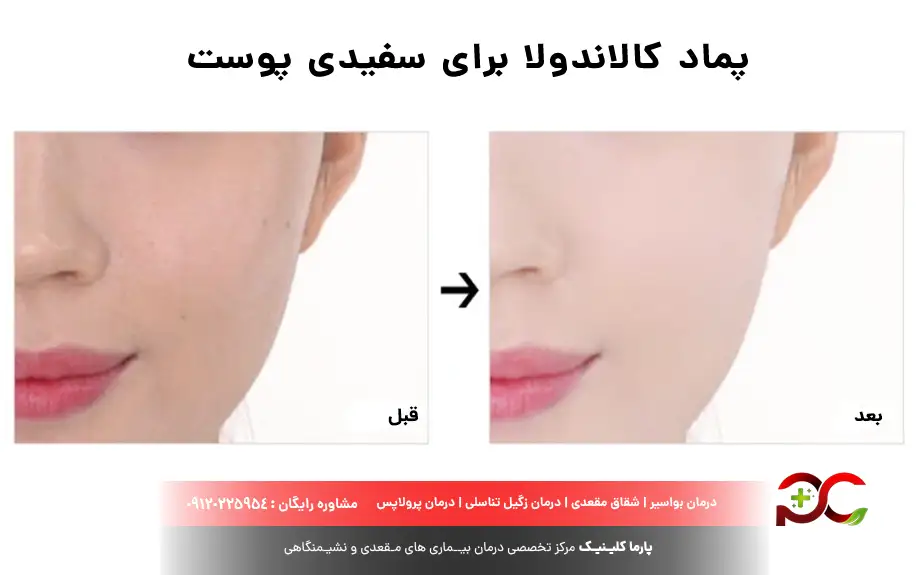 پماد کالاندولا برای سفیدی پوست