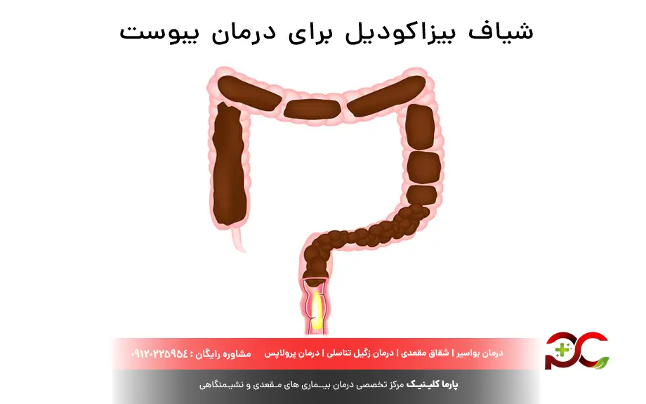 شیاف بیزاکودیل برای درمان یبوست