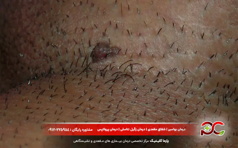 توده تناسلی در مردان