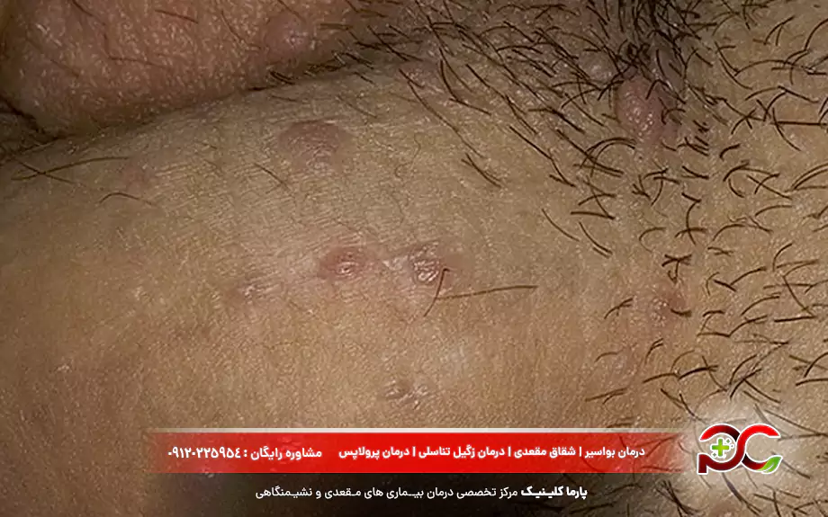 توده تناسلی چیست