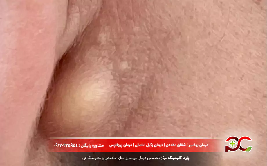 توده کروی در زیر پوست اندام تناسلی