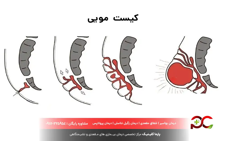 کیست مویی؛ علل، علائم و درمان آن