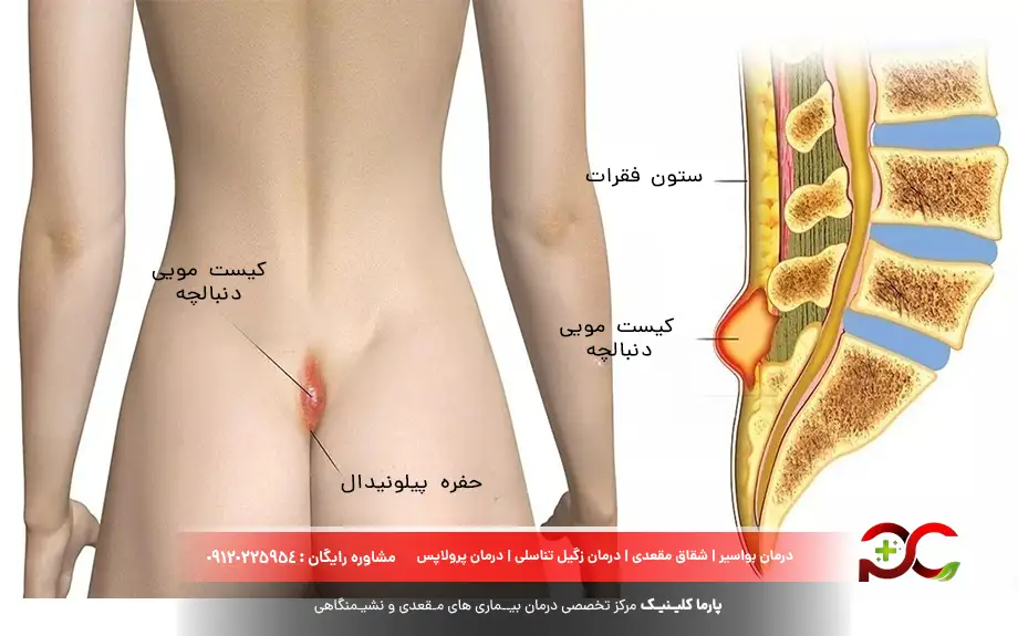 کیست مویی دنبالچه
