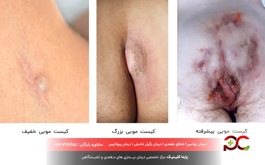 عکس کیست مویی در مراحل اولیه