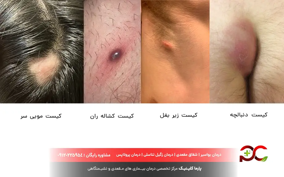 انواع کیست مویی 