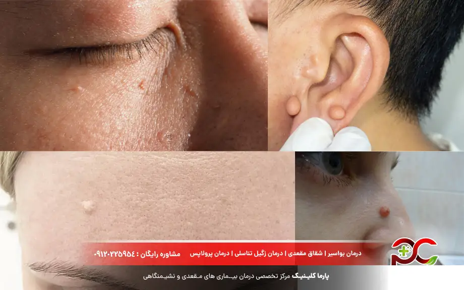 انواع زگیل پوست صورت