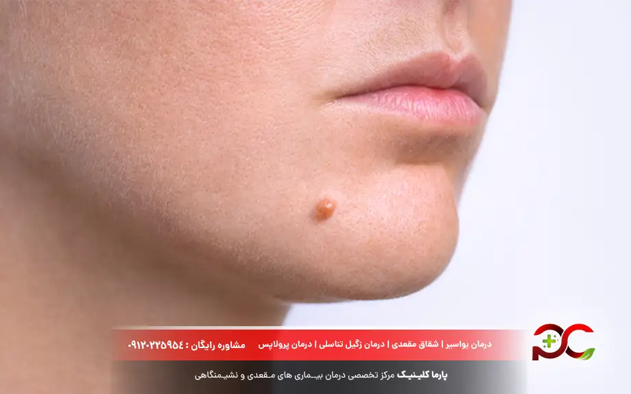 عکس زگیل صورت