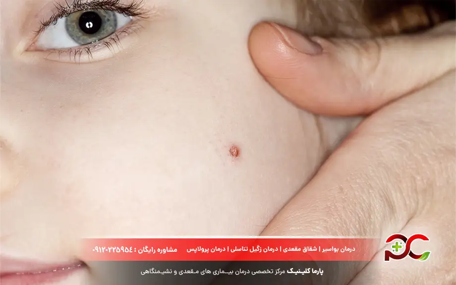 عکس زگیل صورت در کودکان