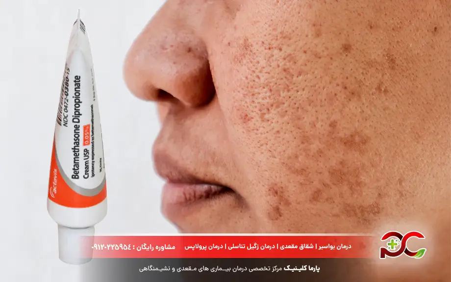 پماد بتامتازون برای لک صورت