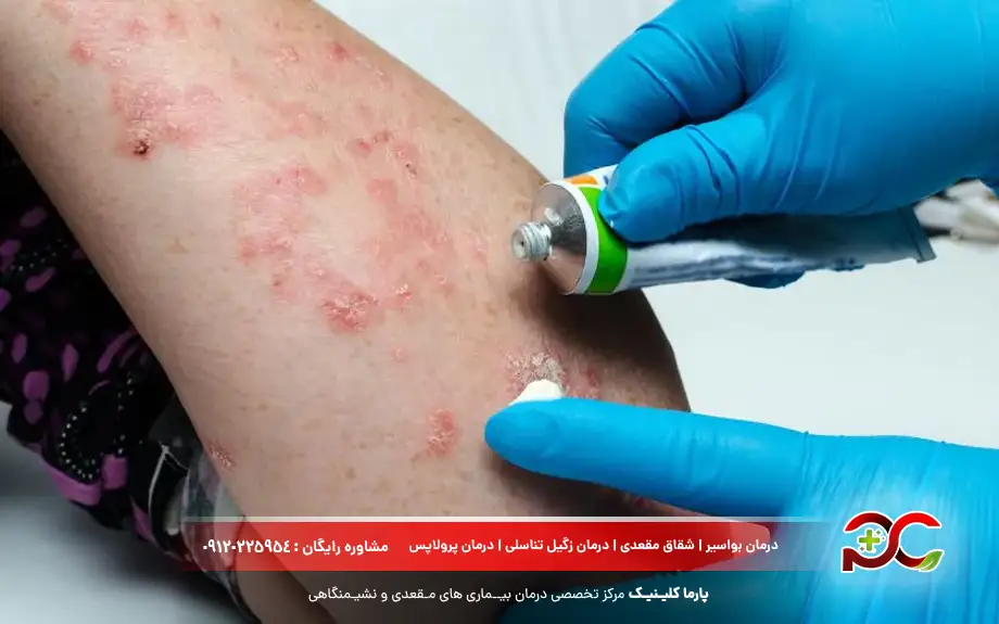 پماد بتامتازون برای قارچ پوستی