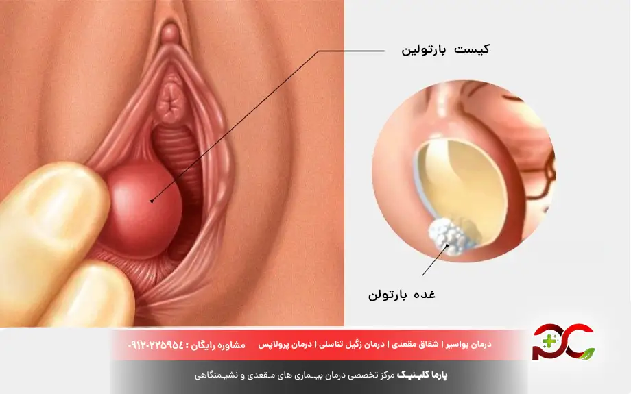 عکس واقعی کیست بارتولن
