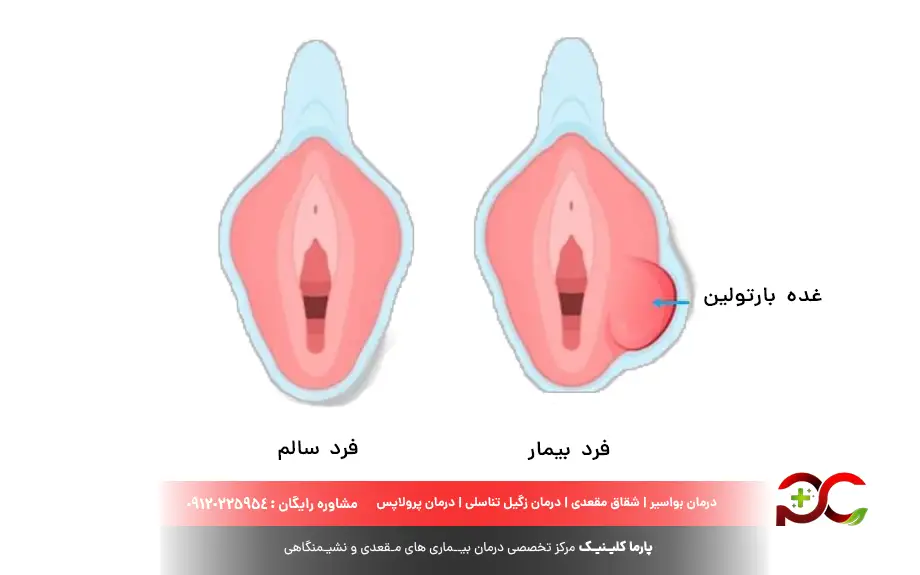 کیست بارتولین