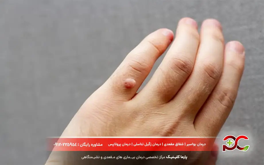 زگیل چیست؟