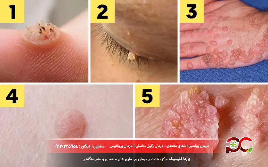 انواع زگیل 