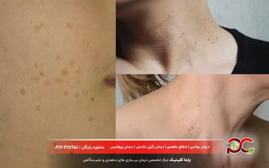 زگیل های صاف