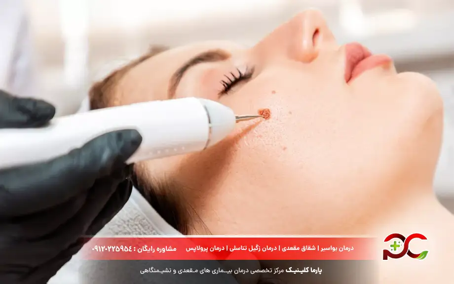 سوزاندن و لیزر برای درمان زگیل