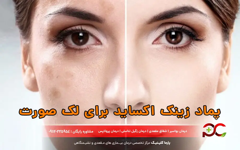 پماد زینک اکساید برای لک صورت