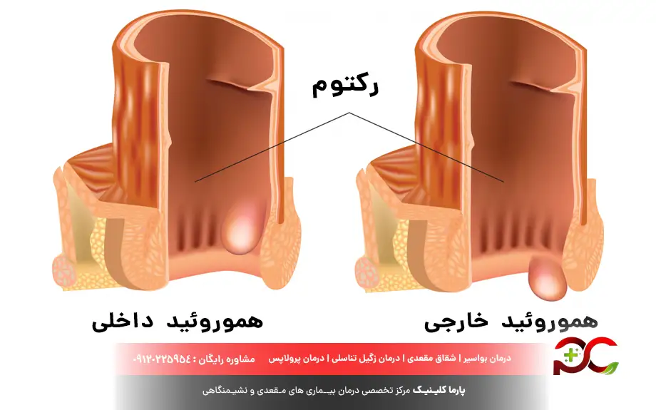 بواسیر داخلی