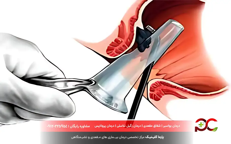 لیزر هموروئید داخلی