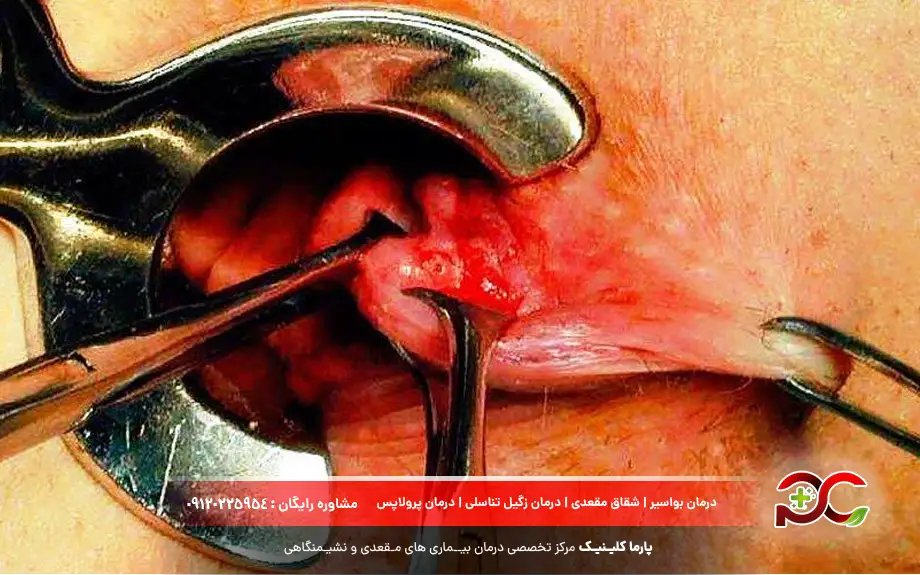عکس هموروئید داخلی