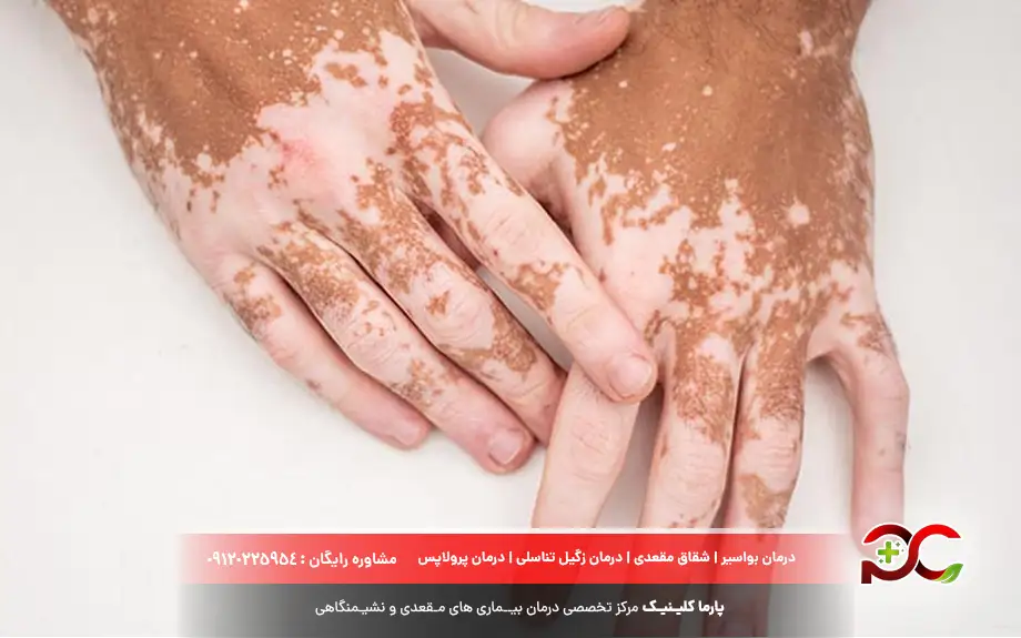 پماد بتامتازون برای درمان پیسی