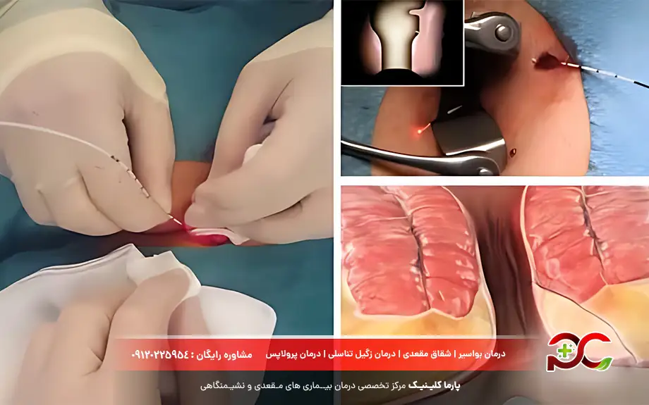 بهترین نوع عمل بواسیر