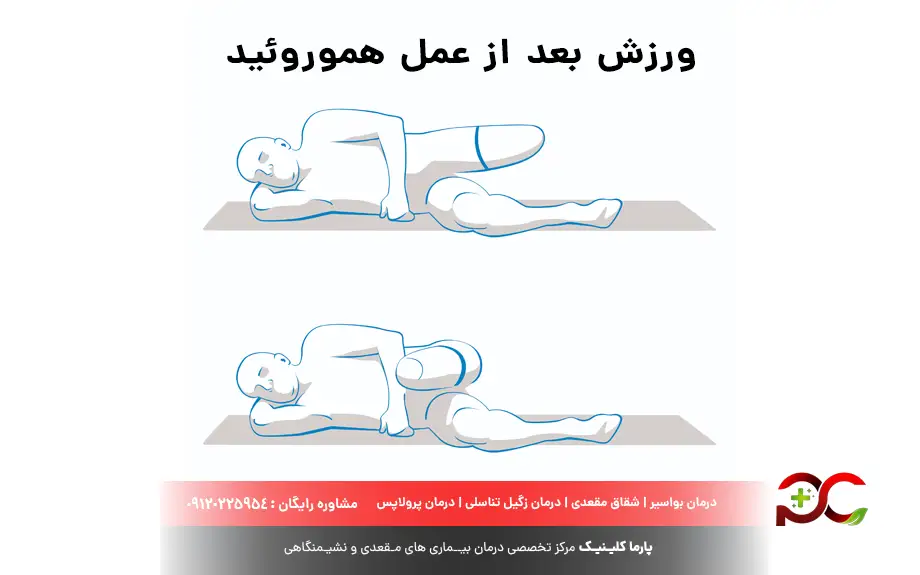 ورزش بعد از عمل هموروئید