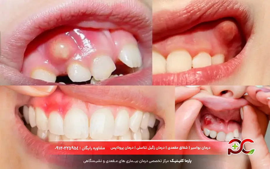 فیستول دندان