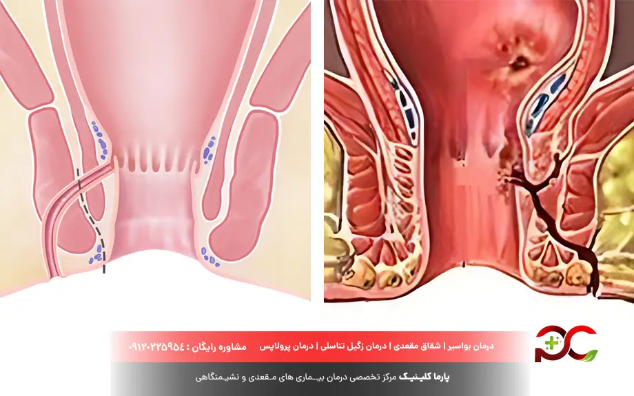 فیستول مقعدی