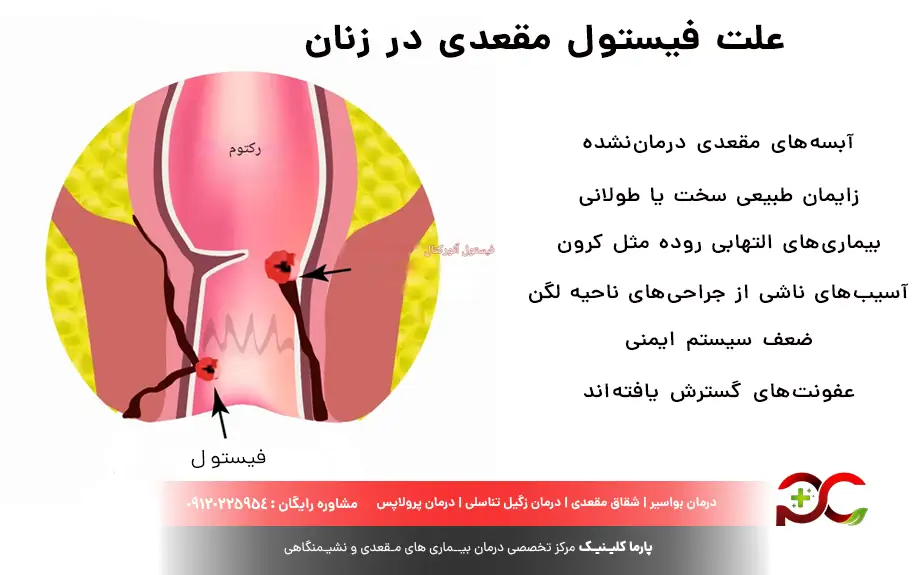علت فیستول مقعدی در زنان
