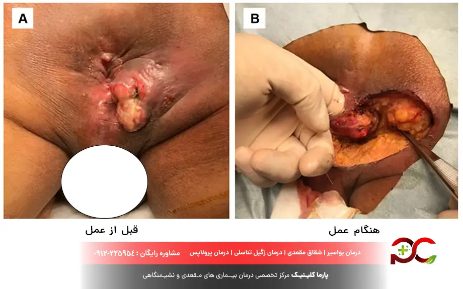 عکس فیستول