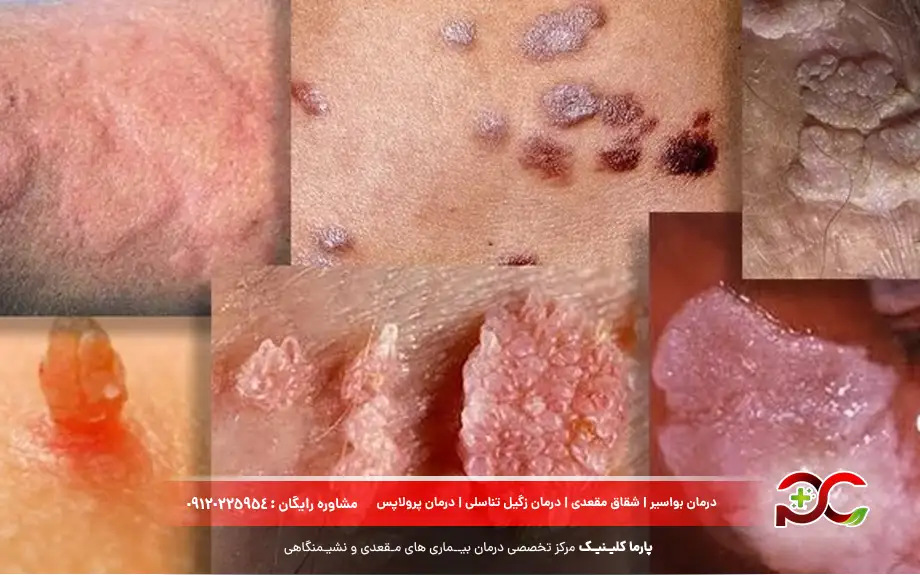 علت عود زگیل تناسلی