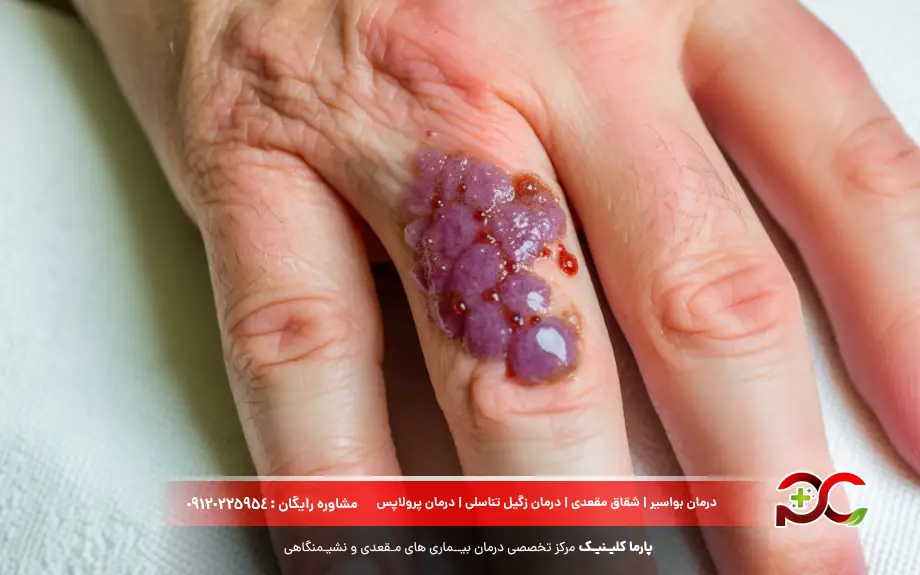 عود زگیل تناسلی بعد از کرایو