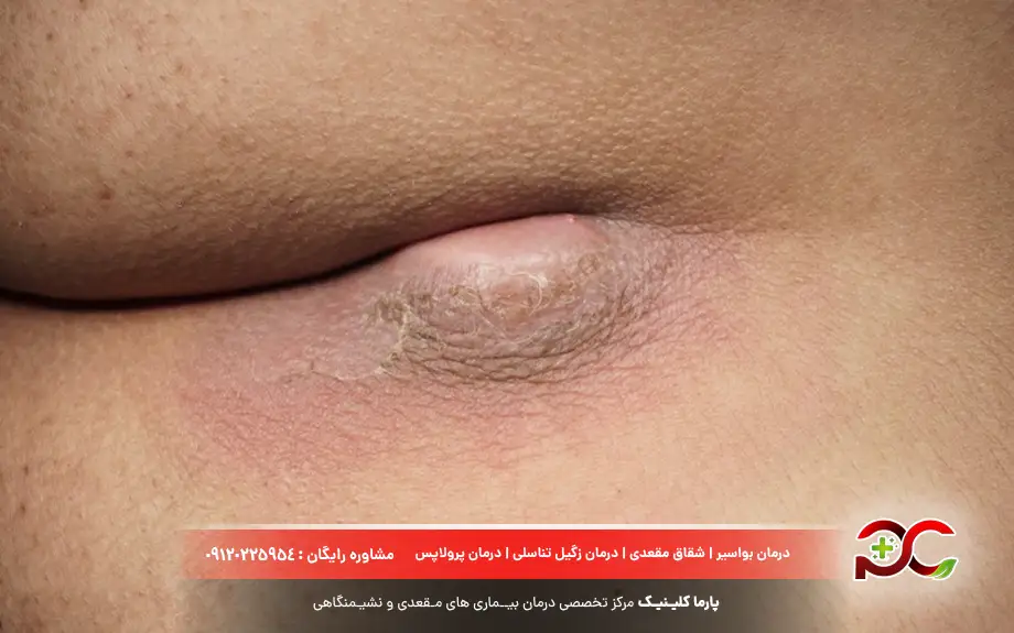 عکس بیماری آبسه مقعدی