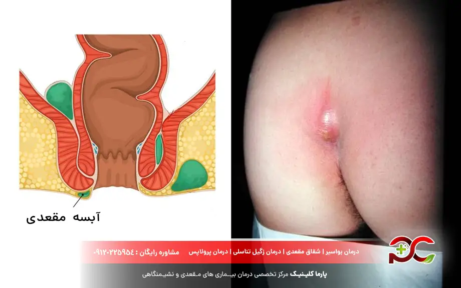 آبسه مقعدی چیست؟