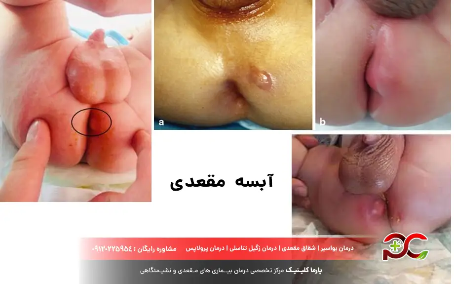 آبسه مقعدی در کودکان