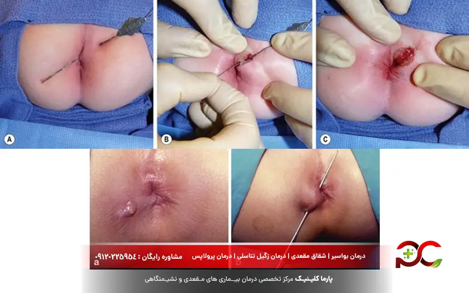 تخلیه آبسه مقعدی