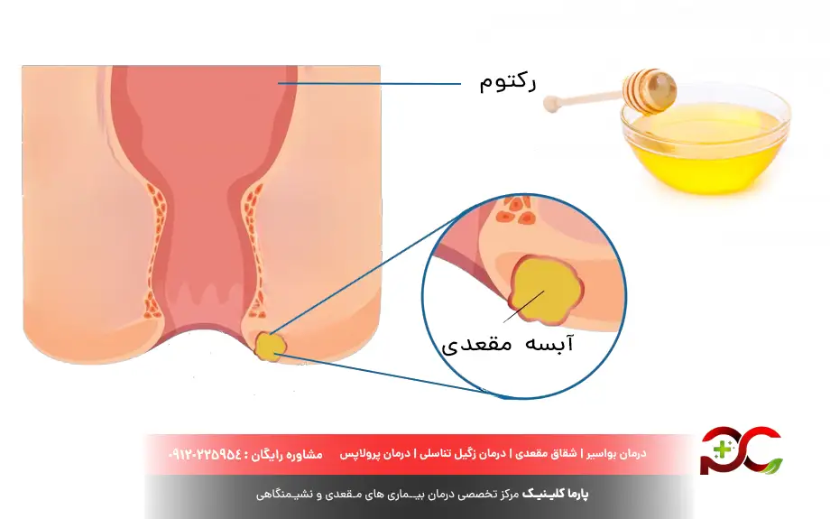 درمان آبسه مقعدی با عسل