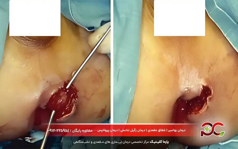 آبسه مقعدی در مردان