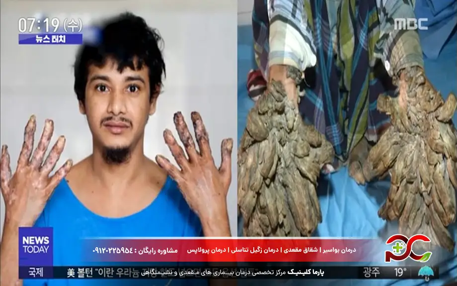 جراحی بیماری درختی