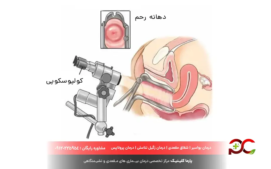 کولپوسکوپی برای اچ پی وی