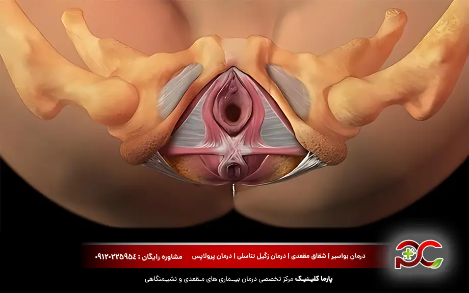 ترمیم پارگی اسفنکتر