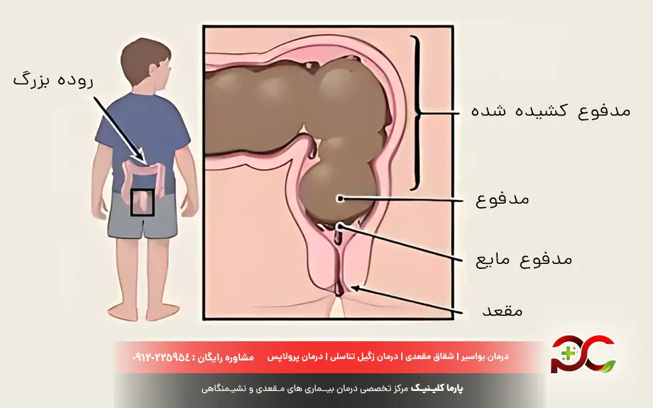رفلاکس مدفوع چیست؟