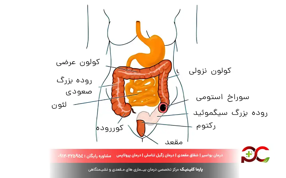 درمان بازگشت مدفوع به روده