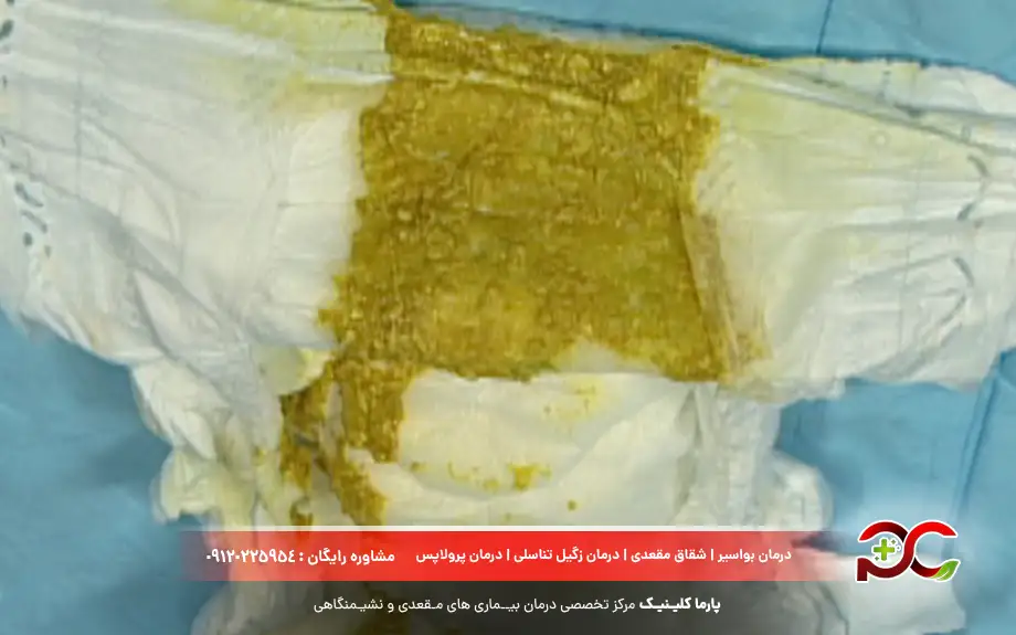 مدفوع نوزاد رفلاکسی