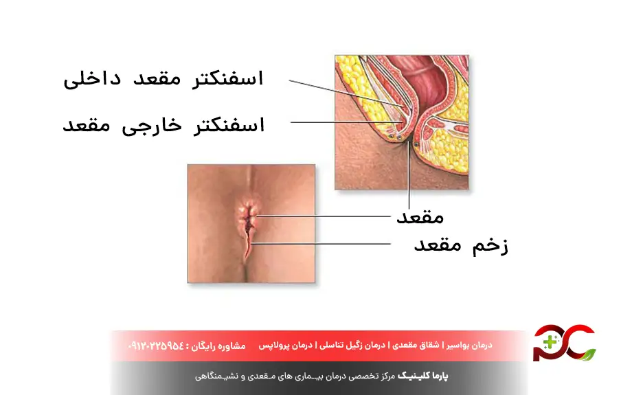 زخم مقعدی چیست؟