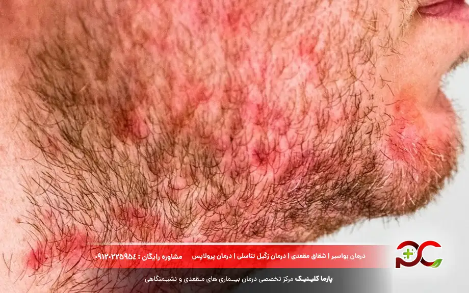 عکس فولیکولیت مو