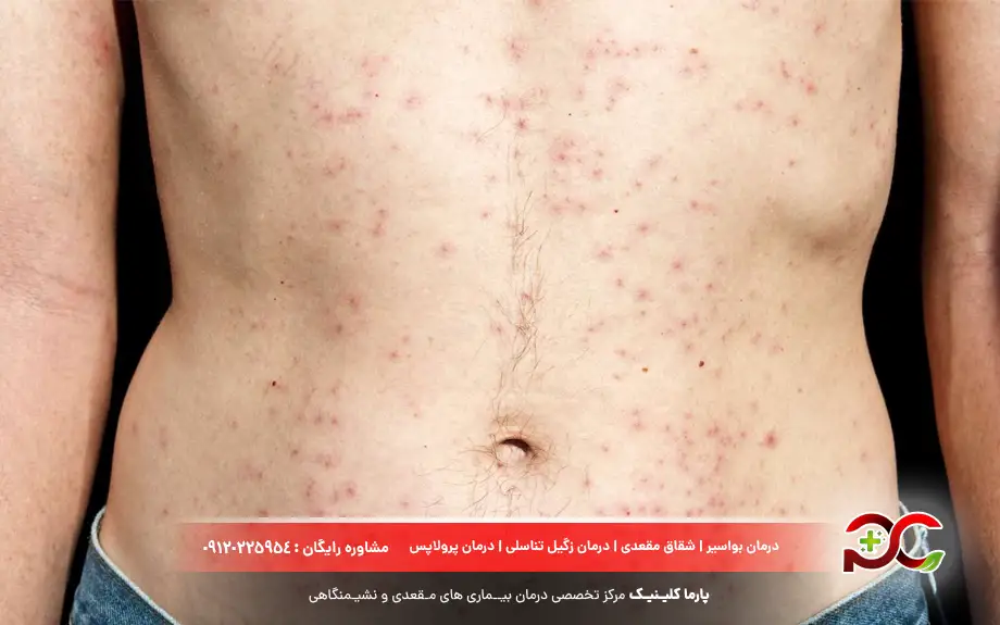 جوش فولیکول مو