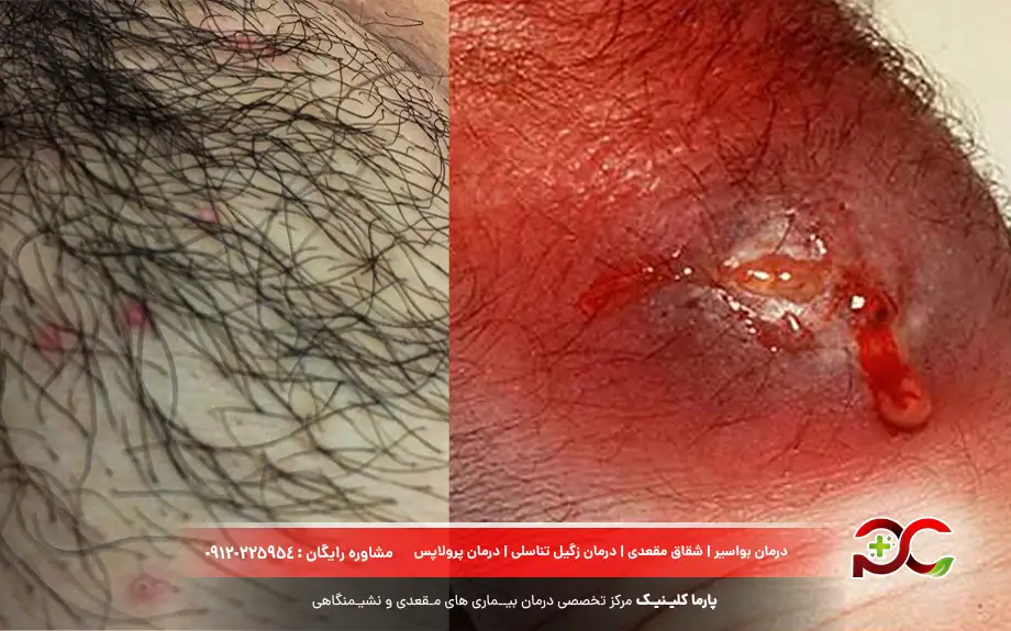 فولیکولیت در ناحیه تناسلی